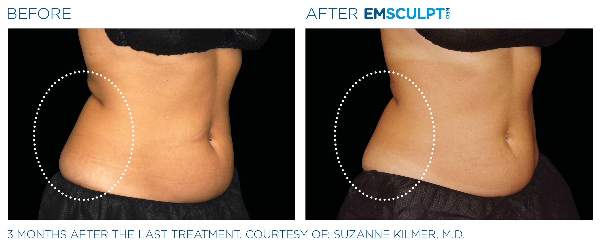 AbdomenEmsculpt_Neo_PIC_Ba-card-female-lateral-abdomen-178_ENUS100.png