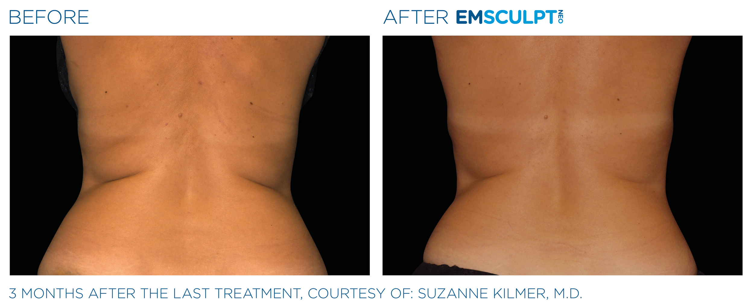 AbdomenEmsculpt_Neo_PIC_Ba-card-female-lateral-abdomen-179_ENUS100.png
