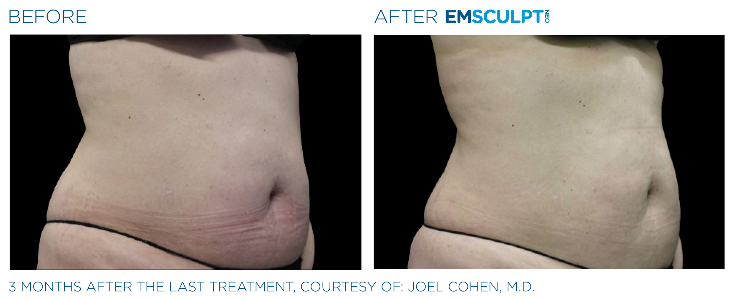 AbdomenEmsculpt_Neo_PIC_Ba-card-female-lateral-abdomen-181_ENUS100.png