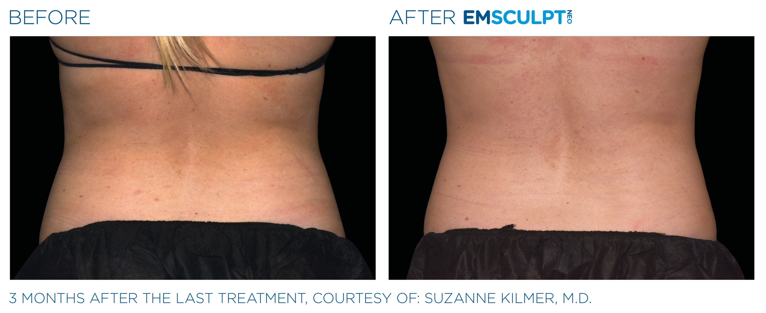 AbdomenEmsculpt_Neo_PIC_Ba-card-female-lateral-abdomen-180_ENUS100.png