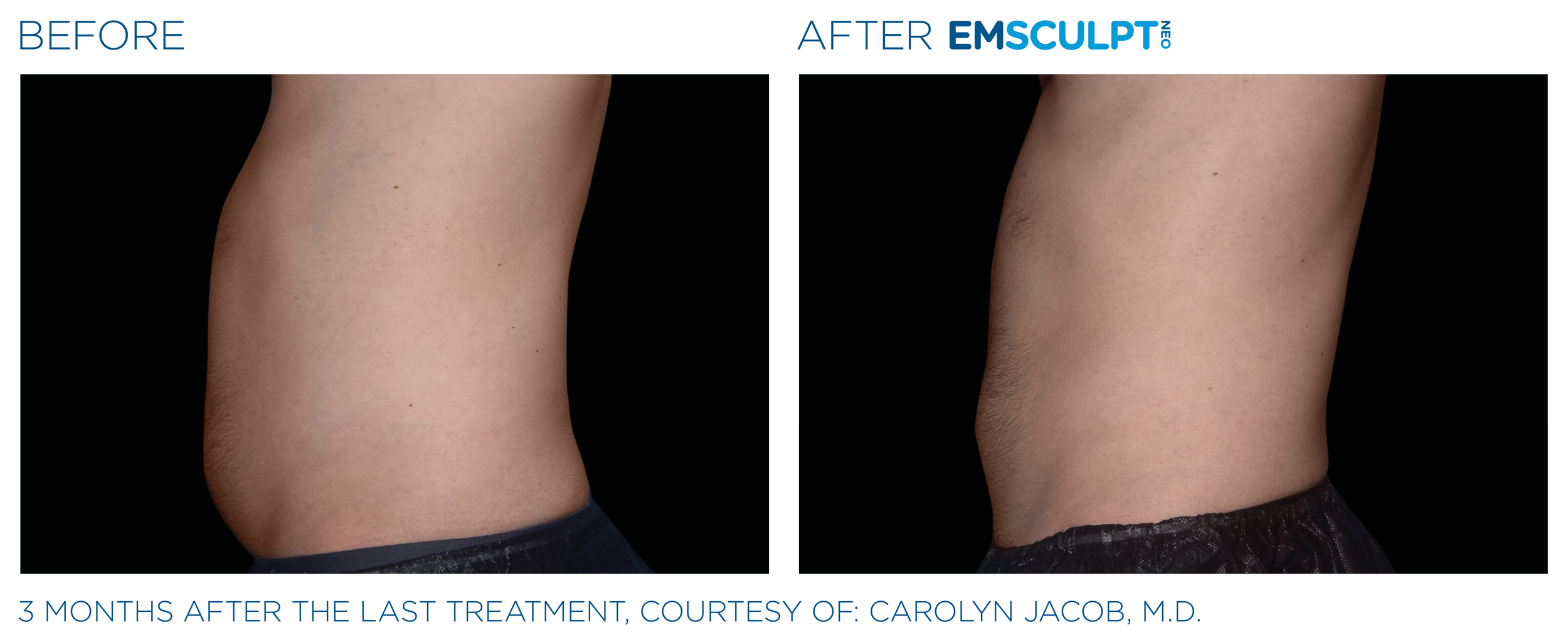 AbdomenEmsculpt_neo_PIC_Ba-card-male-abdomen-001_ENUS100.png