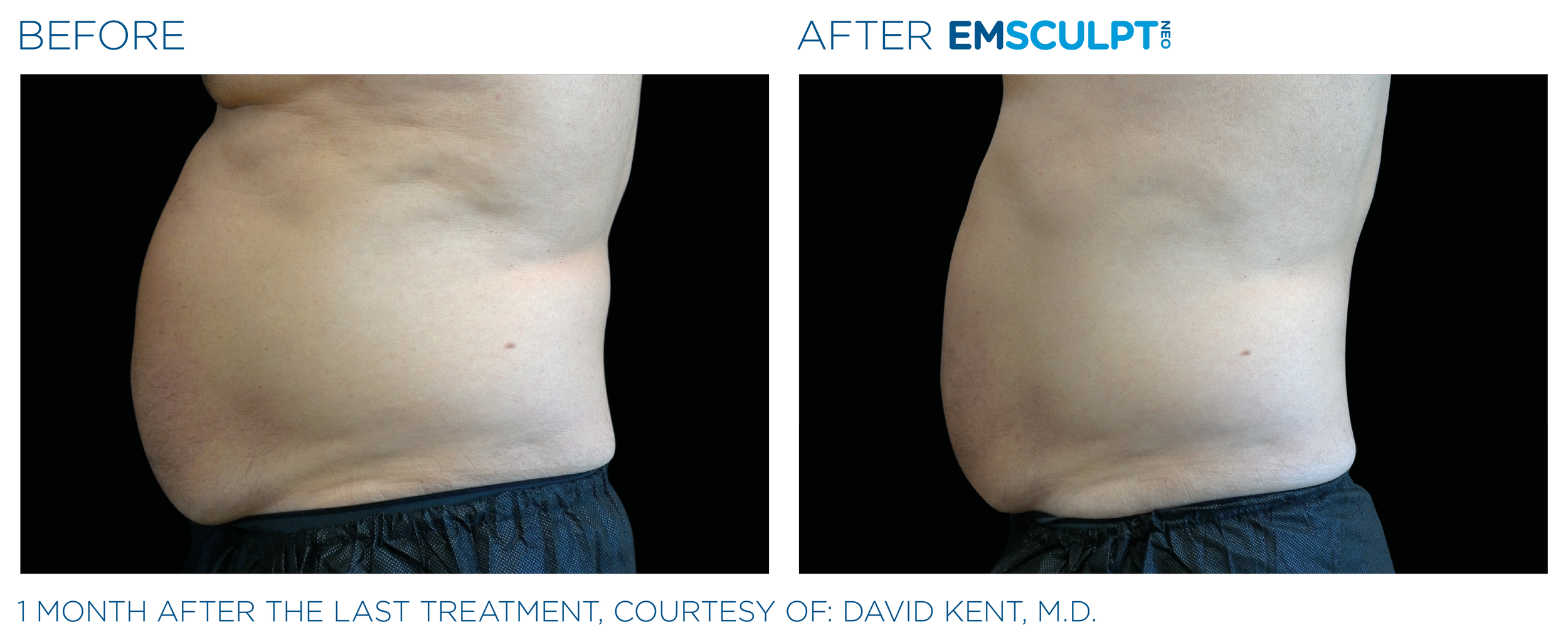 AbdomenEmsculpt_neo_PIC_Ba-card-male-abdomen-002_ENUS100.png