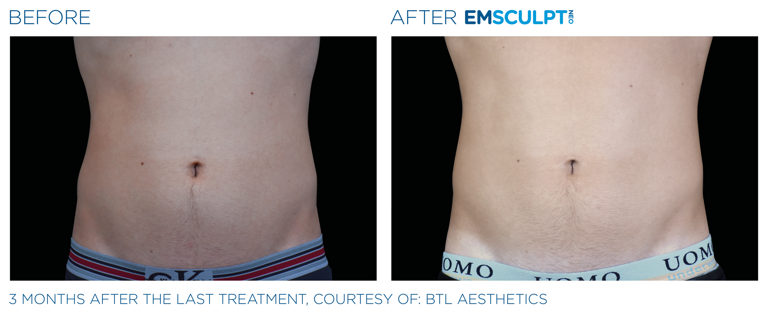 AbdomenEmsculpt_neo_PIC_Ba-card-male-abdomen-012_ENUS100.png