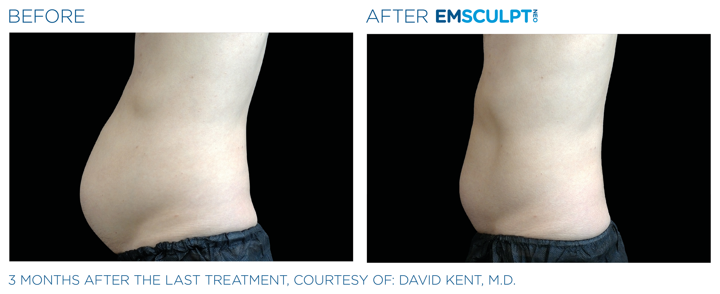 AbdomenEmsculpt_neo_PIC_Ba-card-male-abdomen-022_ENUS100.png