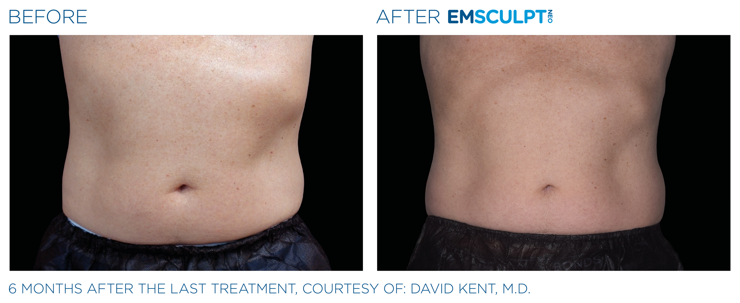AbdomenEmsculpt_neo_PIC_Ba-card-male-abdomen-043_ENUS100.png