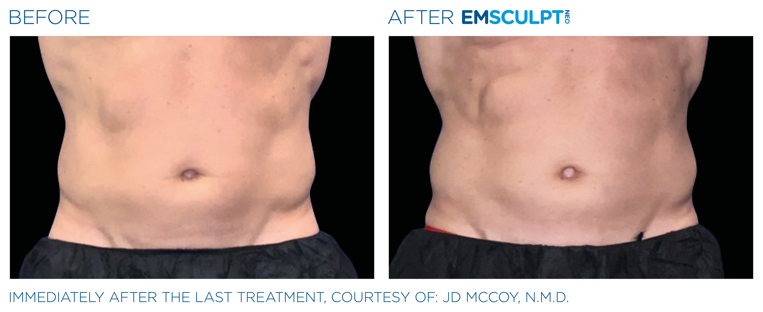AbdomenEmsculpt_Neo_PIC_Ba-card-male-lateral-abdomen-119_ENUS100.png