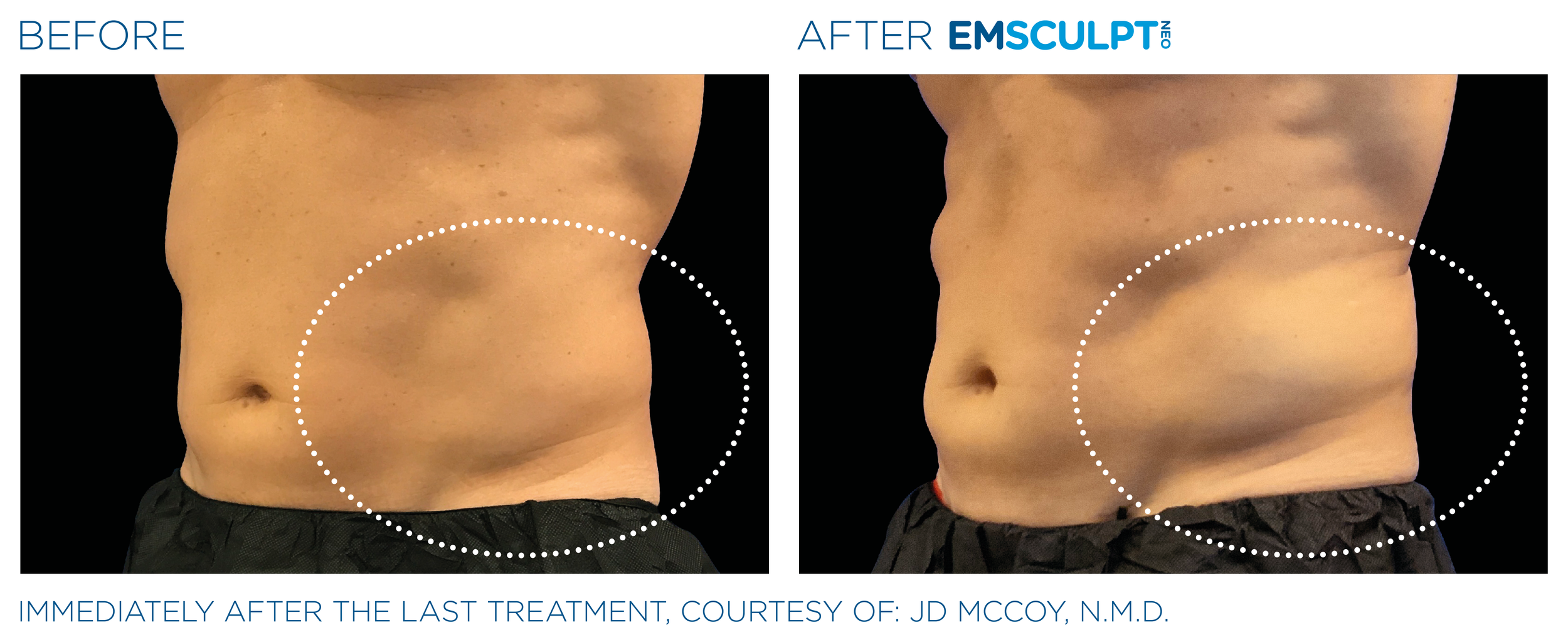 AbdomenEmsculpt_Neo_PIC_Ba-card-male-lateral-abdomen-121_ENUS100.png