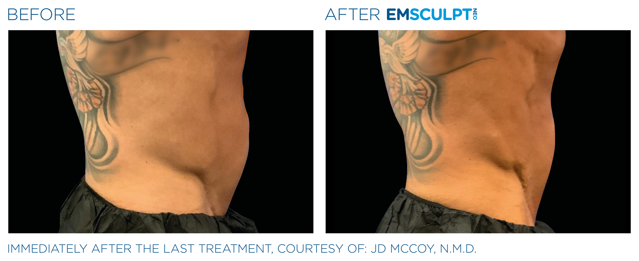 AbdomenEmsculpt_Neo_PIC_Ba-card-male-lateral-abdomen-122_ENUS100.png