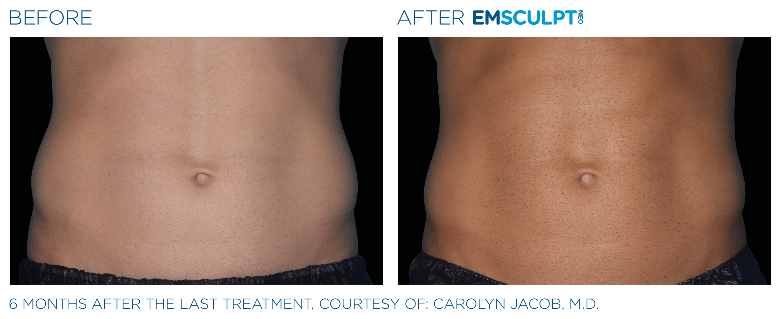 AbdomenEmsculpt_neo_PIC_Ba-card-male-abdomen-090_ENUS100.png
