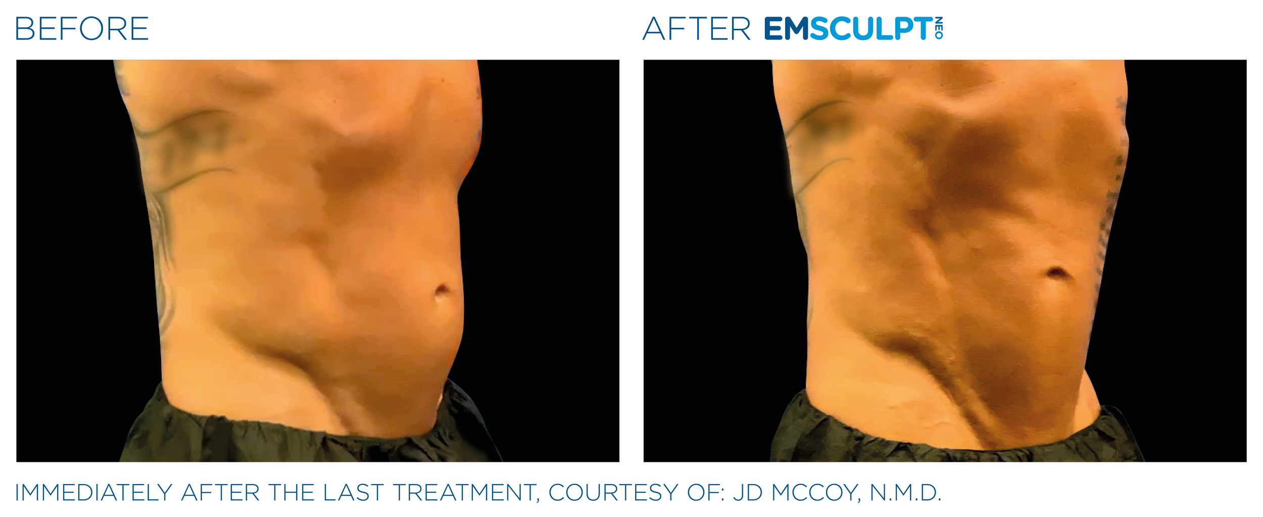 AbdomenEmsculpt_Neo_PIC_Ba-card-male-lateral-abdomen-123_ENUS100.png