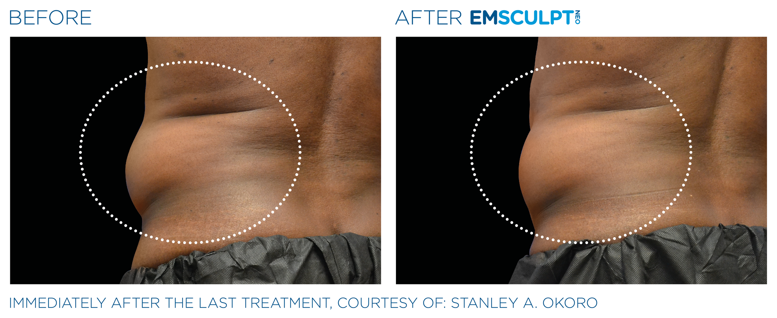 AbdomenEmsculpt_Neo_PIC_Ba-card-male-lateral-abdomen-125_ENUS100.png