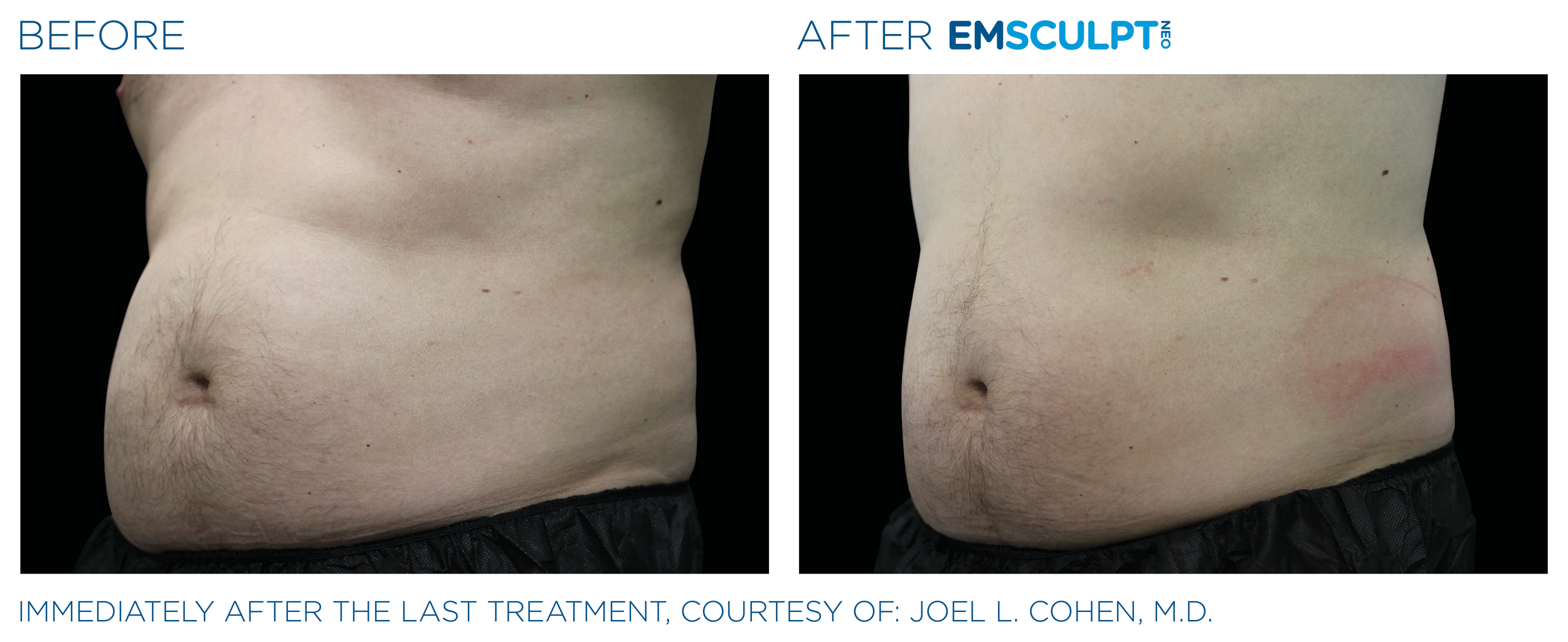 AbdomenEmsculpt_Neo_PIC_Ba-card-male-lateral-abdomen-126_ENUS100.png