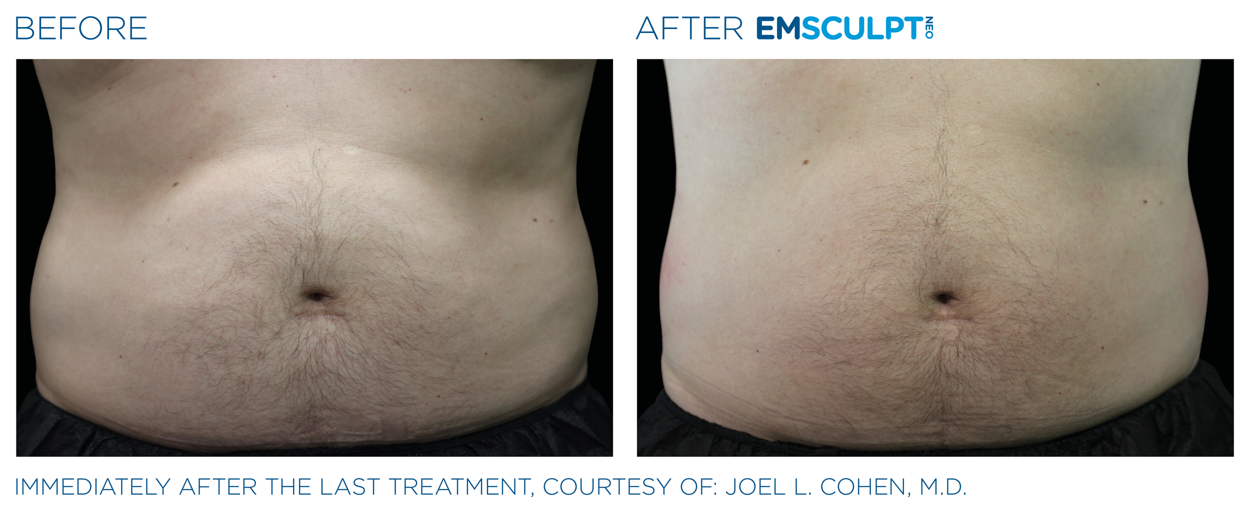AbdomenEmsculpt_Neo_PIC_Ba-card-male-lateral-abdomen-130_ENUS100.png