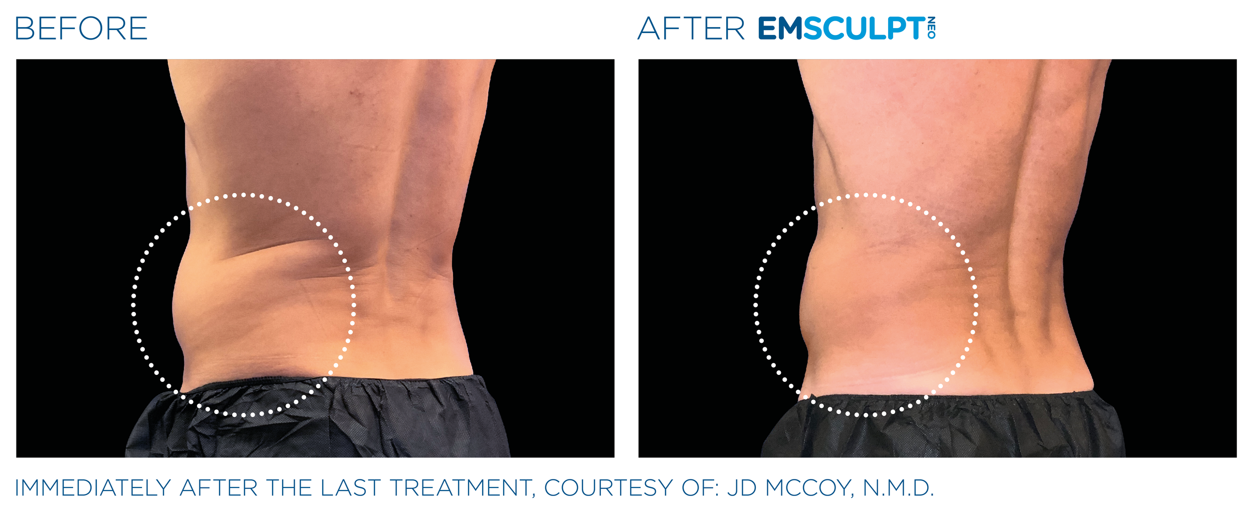 AbdomenEmsculpt_Neo_PIC_Ba-card-male-lateral-abdomen-131_ENUS100.png