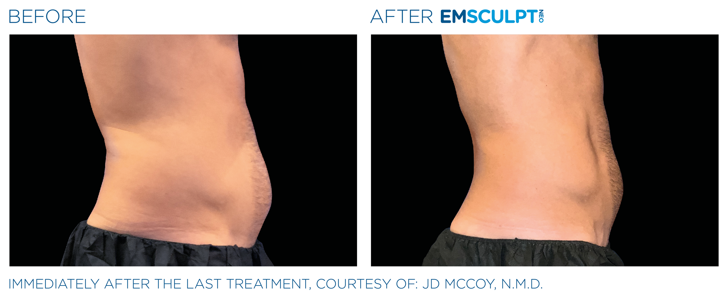 AbdomenEmsculpt_Neo_PIC_Ba-card-male-lateral-abdomen-133_ENUS100.png