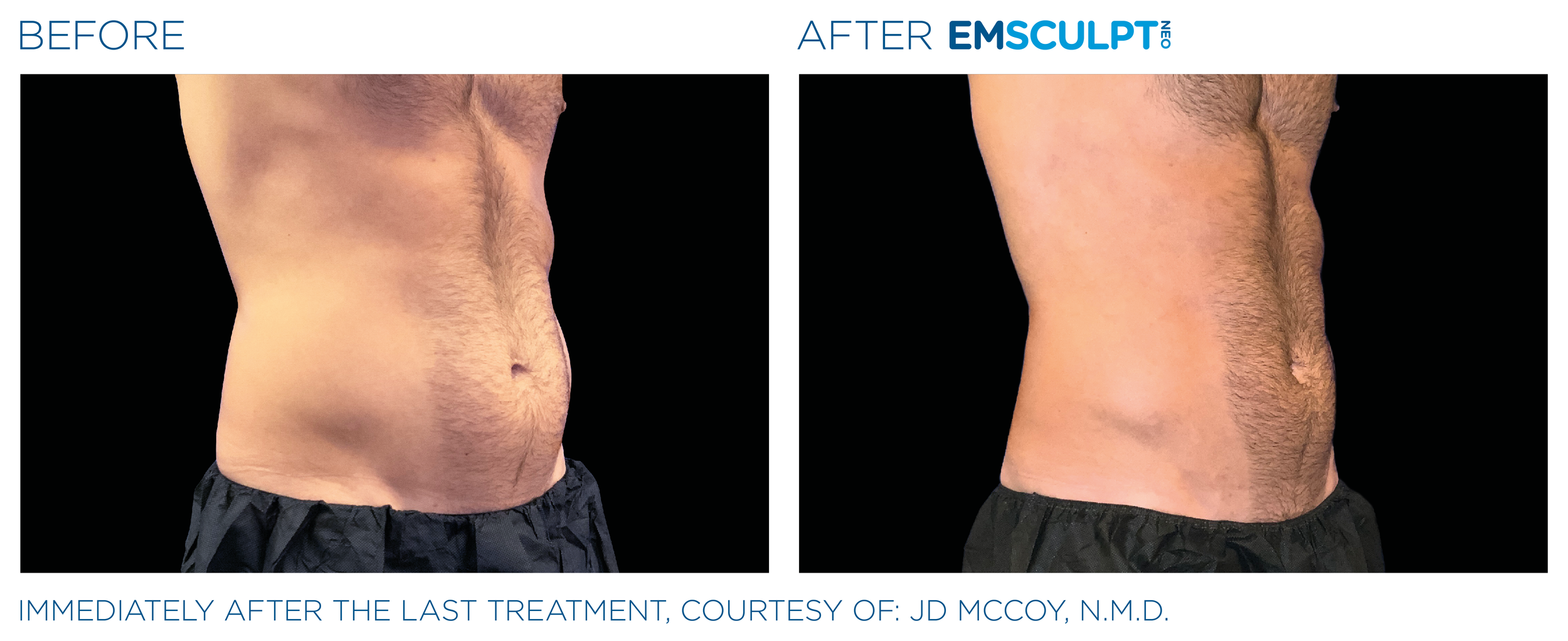 AbdomenEmsculpt_Neo_PIC_Ba-card-male-lateral-abdomen-134_ENUS100.png