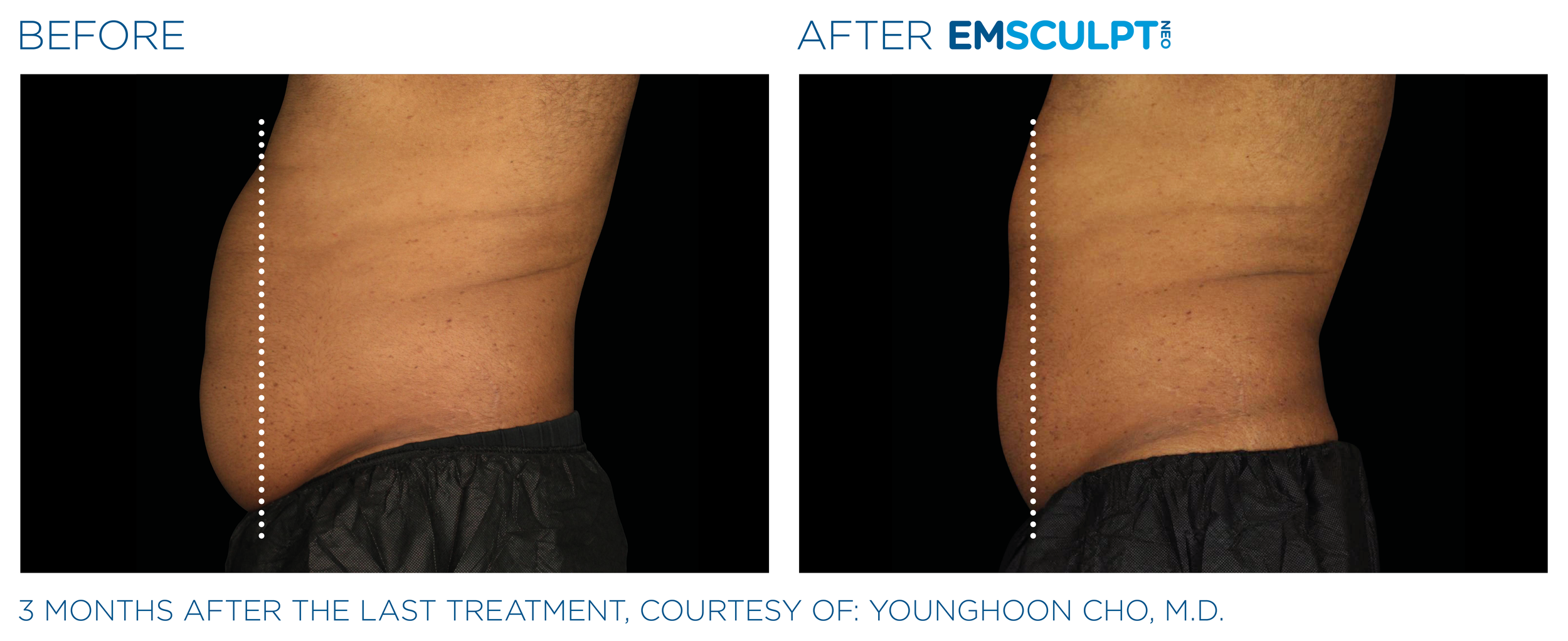 AbdomenEmsculpt_Neo_PIC_Ba-card-male-lateral-abdomen-148_ENUS100.png