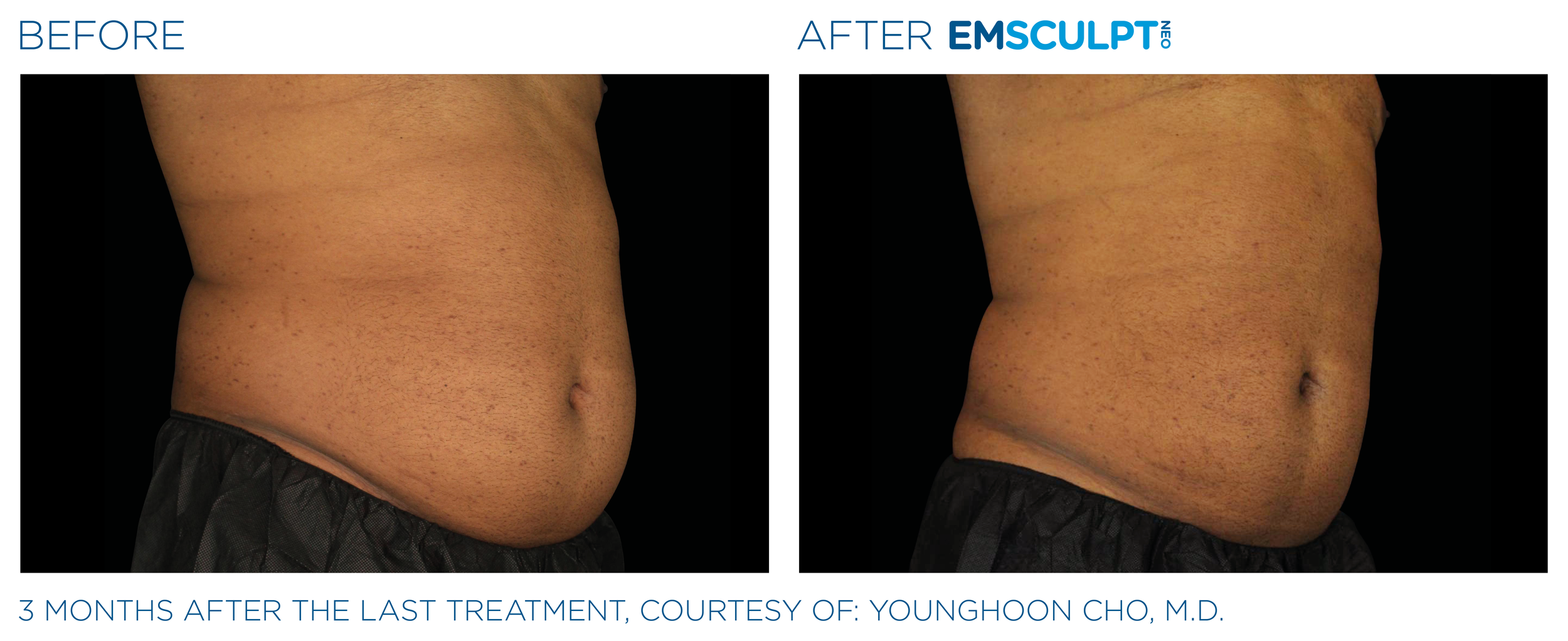 AbdomenEmsculpt_Neo_PIC_Ba-card-male-lateral-abdomen-149_ENUS100.png
