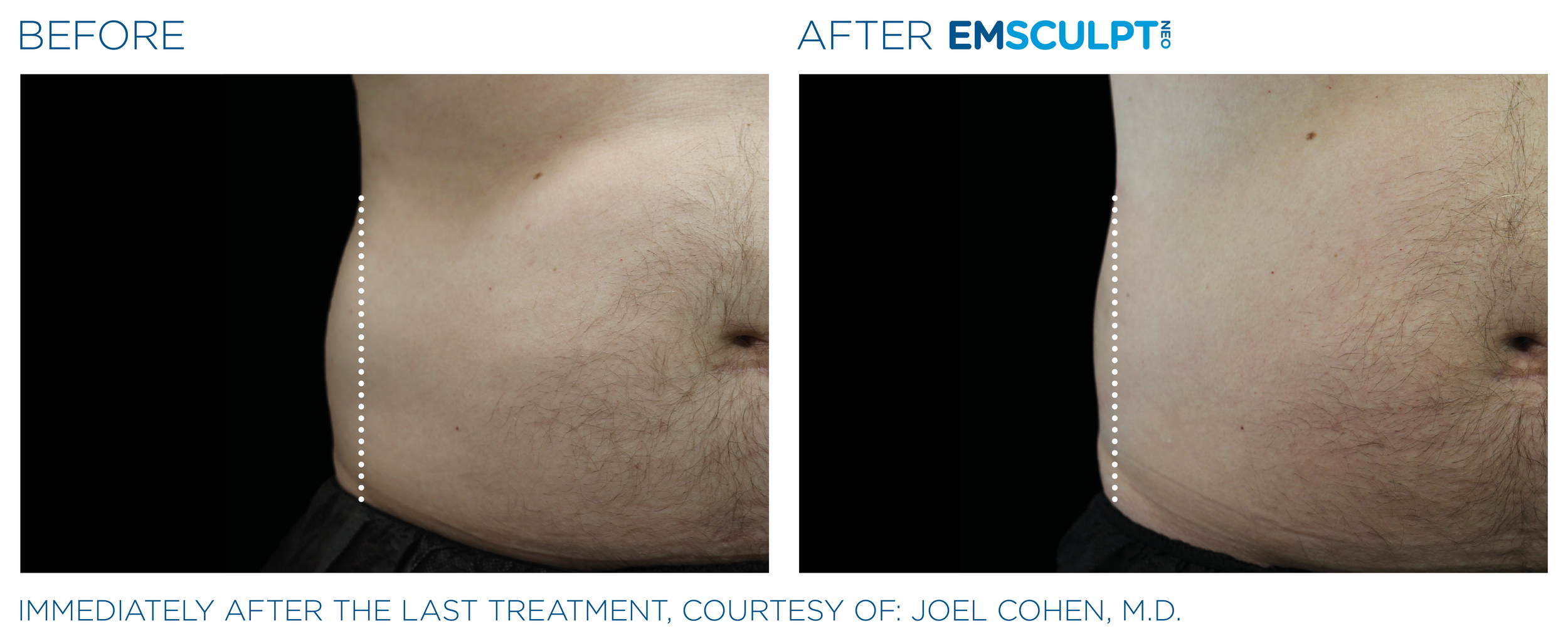 AbdomenEmsculpt_Neo_PIC_Ba-card-male-lateral-abdomen-155_ENUS100.png