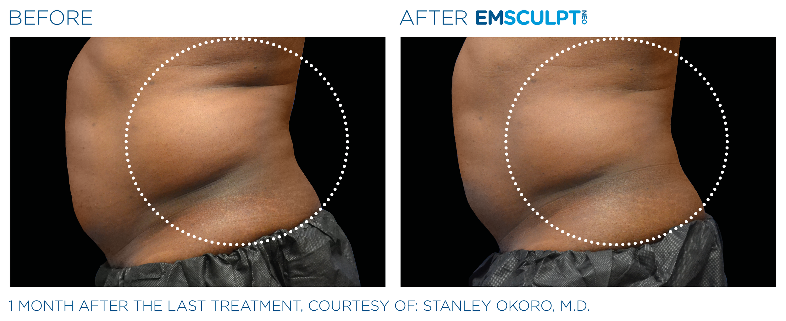 AbdomenEmsculpt_Neo_PIC_Ba-card-male-lateral-abdomen-166_ENUS100.png