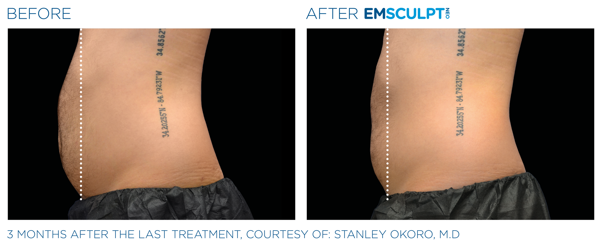 AbdomenEmsculpt_Neo_PIC_Ba-card-male-lateral-abdomen-171_ENUS100.png