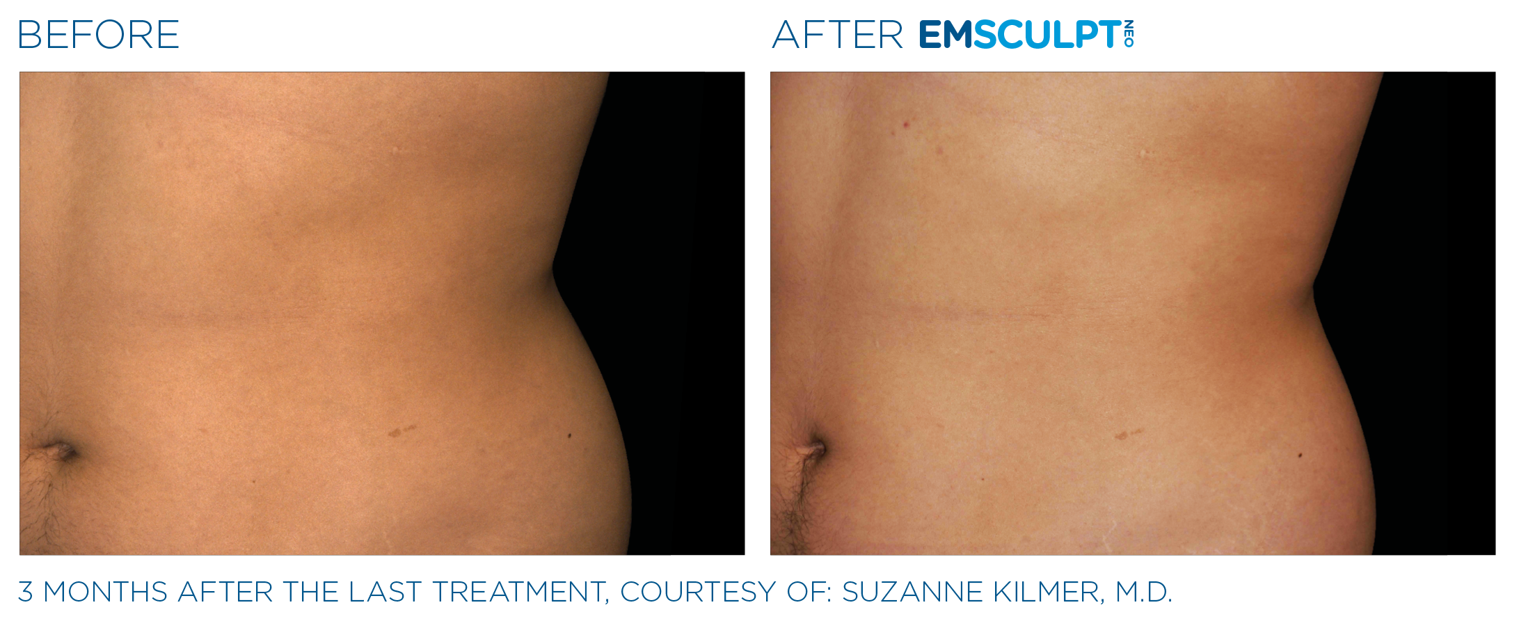 AbdomenEmsculpt_Neo_PIC_Ba-card-male-lateral-abdomen-177_ENUS100.png