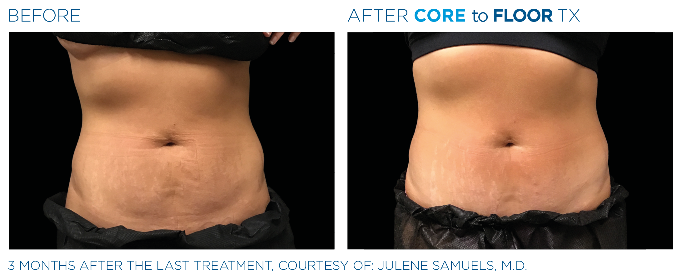AbdomenEmsculpt_Neo-Emsella_PIC_Ba-card-female-abdomen-005_ENUS100.png