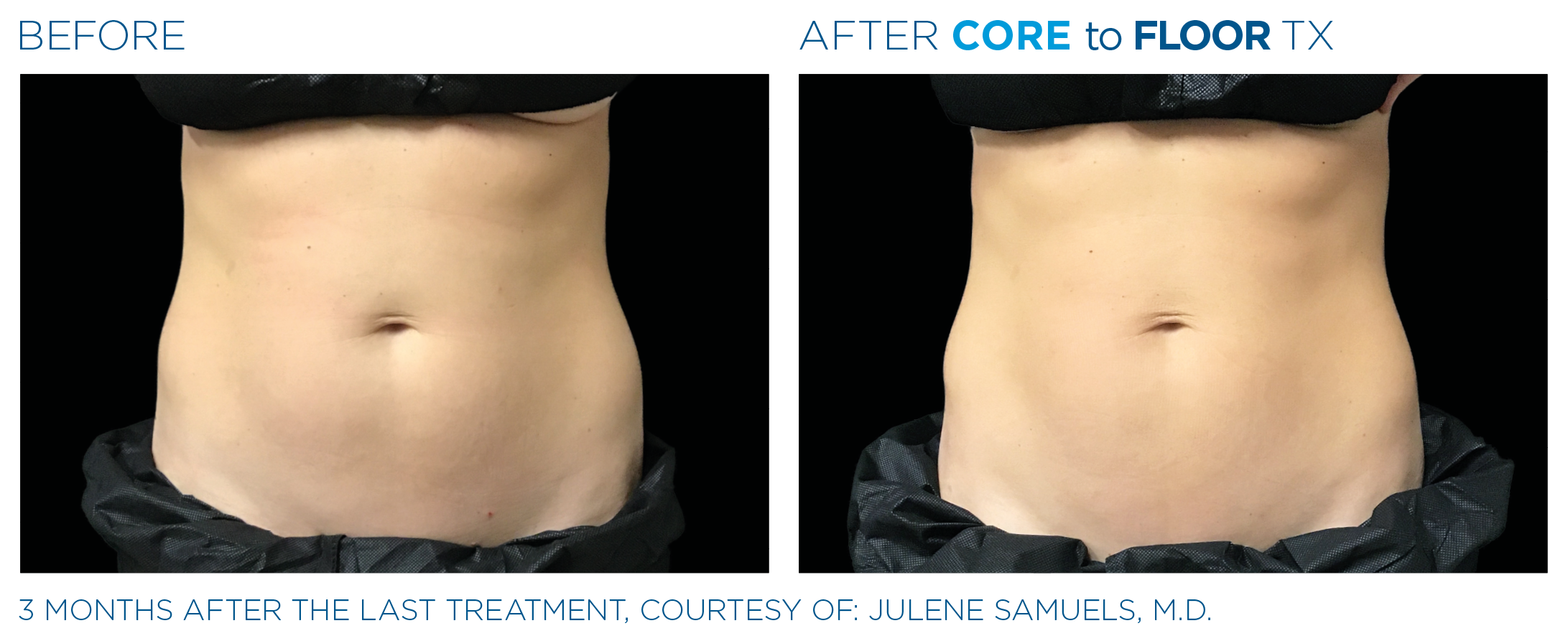 AbdomenEmsculpt_Neo-Emsella_PIC_Ba-card-female-abdomen-006_ENUS100.png