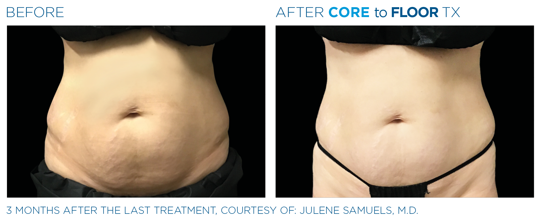 AbdomenEmsculpt_Neo-Emsella_PIC_Ba-card-female-abdomen-007_ENUS100.png