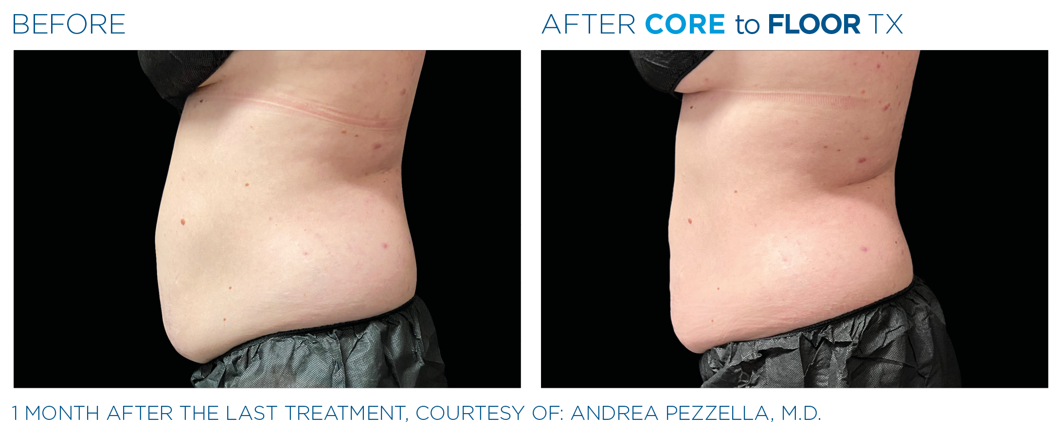 AbdomenEmsculpt_Neo-Emsella_PIC_Ba-card-female-abdomen-018_ENUS100.png