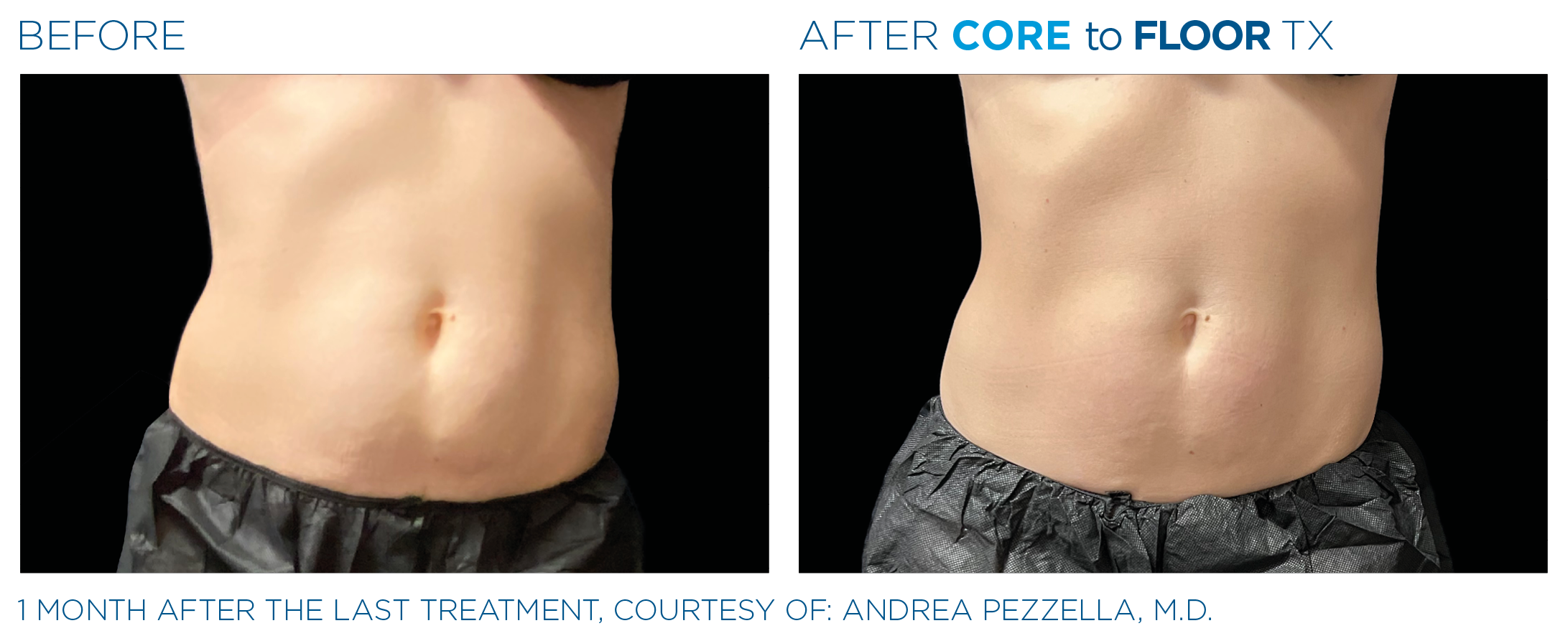 AbdomenEmsculpt_Neo-Emsella_PIC_Ba-card-female-abdomen-019_ENUS100.png