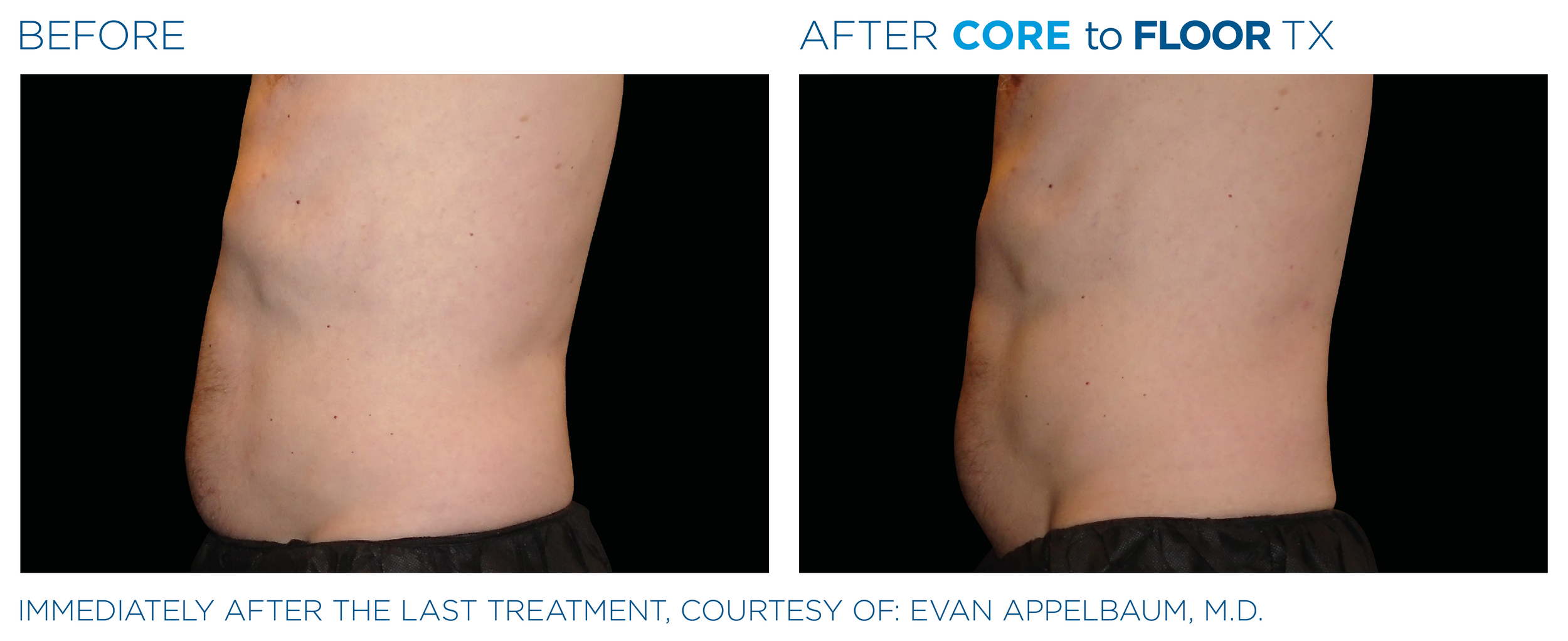 AbdomenEmsculpt_Neo-Emsella_PIC_Ba-card-male-abdomen-020_ENUS100.png