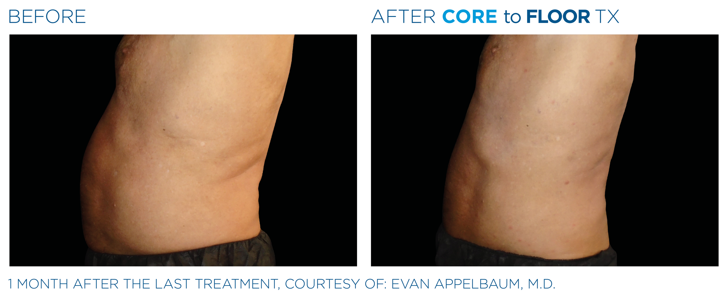 AbdomenEmsculpt_Neo-Emsella_PIC_Ba-card-male-abdomen-024_ENUS100.png