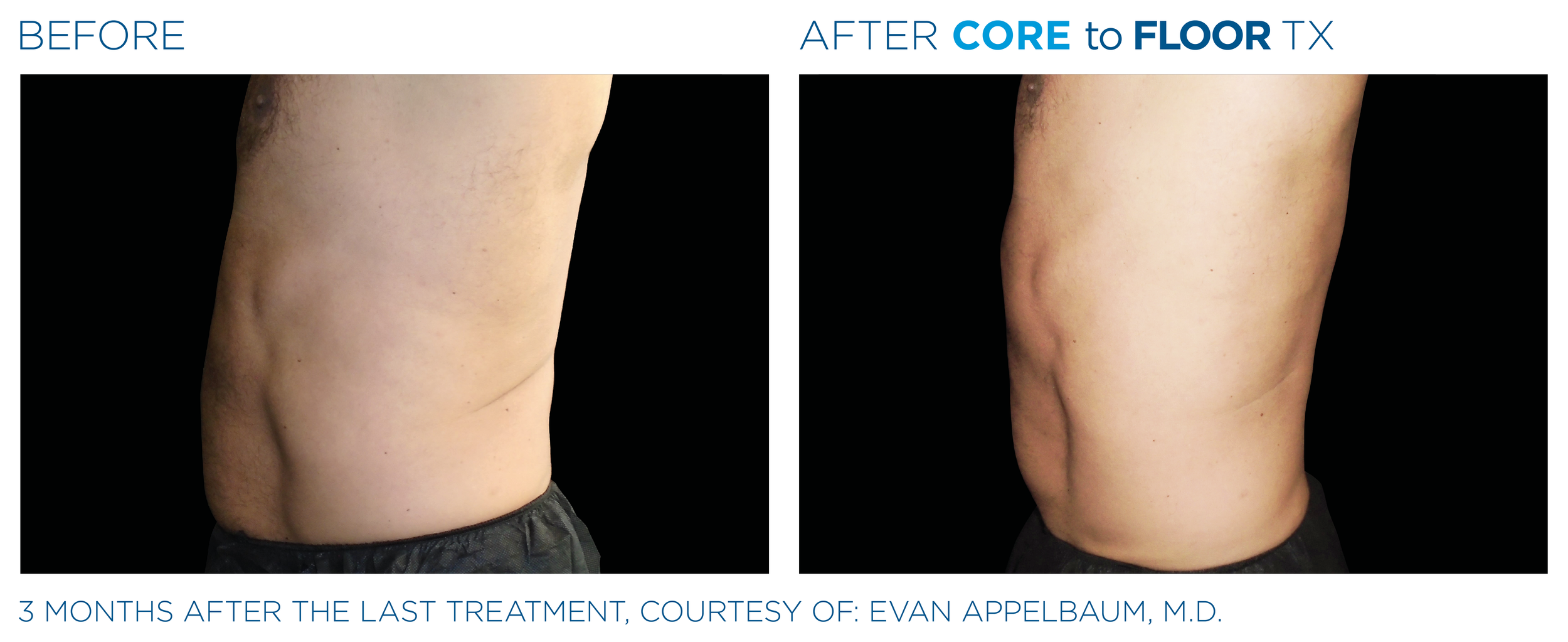 AbdomenEmsculpt_Neo-Emsella_PIC_Ba-card-male-abdomen-023_ENUS100.png