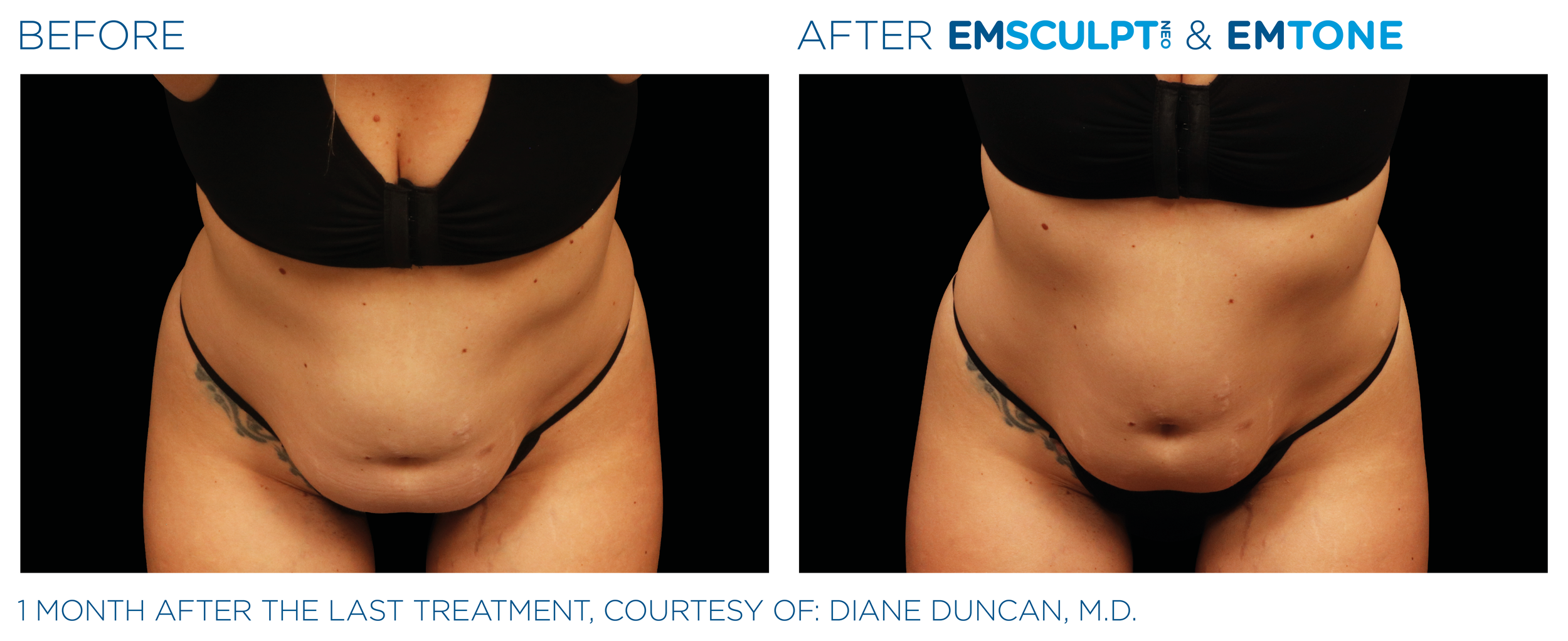 AbdomenEmsculpt_Neo-Emtone_PIC_Ba-card-female-abdomen-003_ENUS100.png