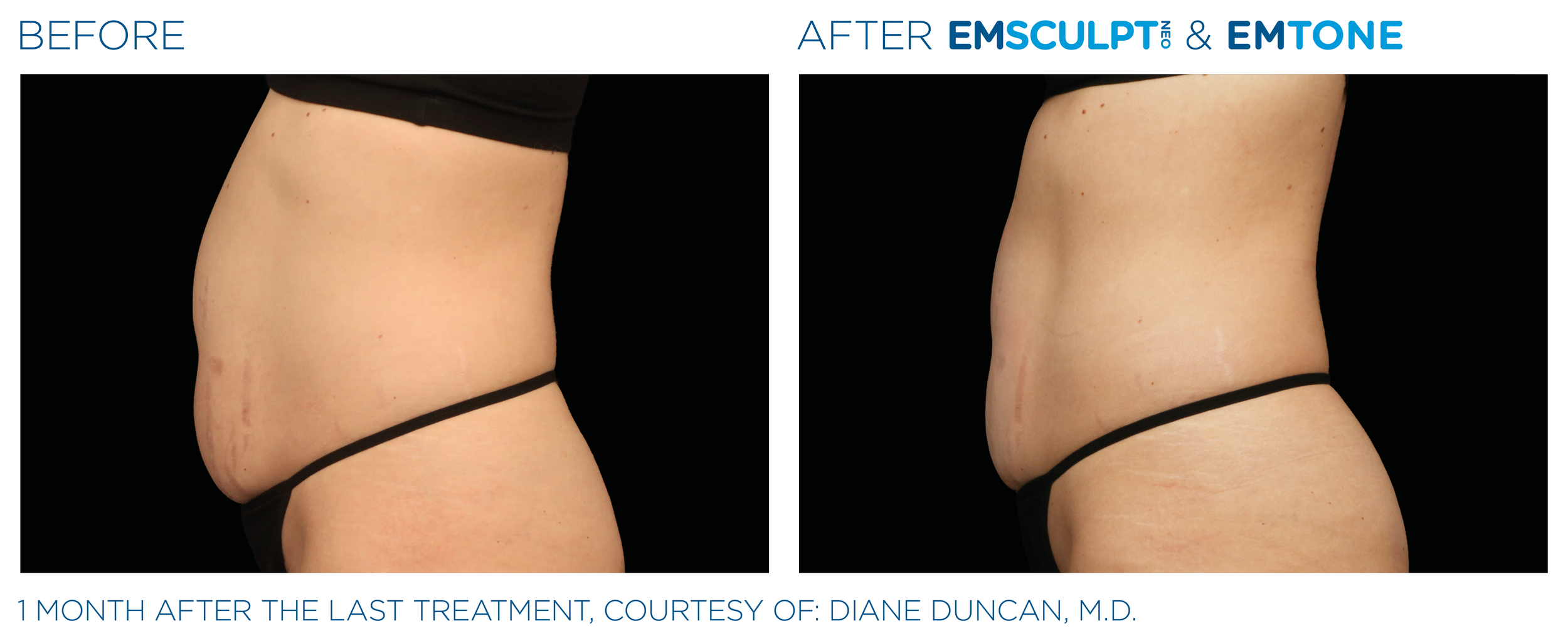 AbdomenEmsculpt_Neo-Emtone_PIC_Ba-card-female-abdomen-004_ENUS100.png