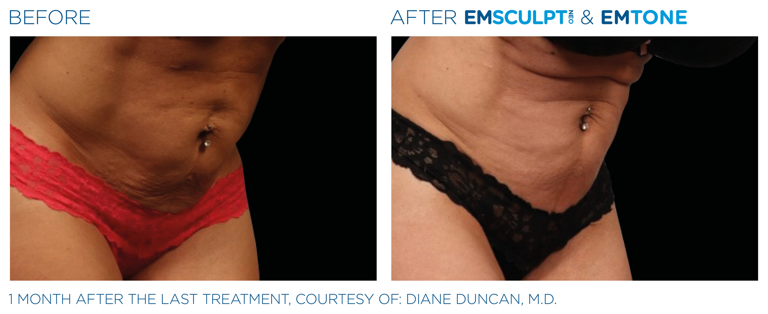 AbdomenEmsculpt_Neo-Emtone_PIC_Ba-card-female-abdomen-010_ENUS100.png