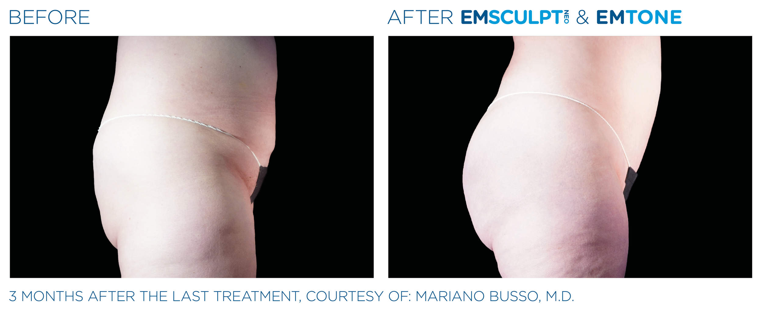 AbdomenEmsculpt_Neo-Emtone_PIC_Ba-card-female-abdomen-009_ENUS100.png