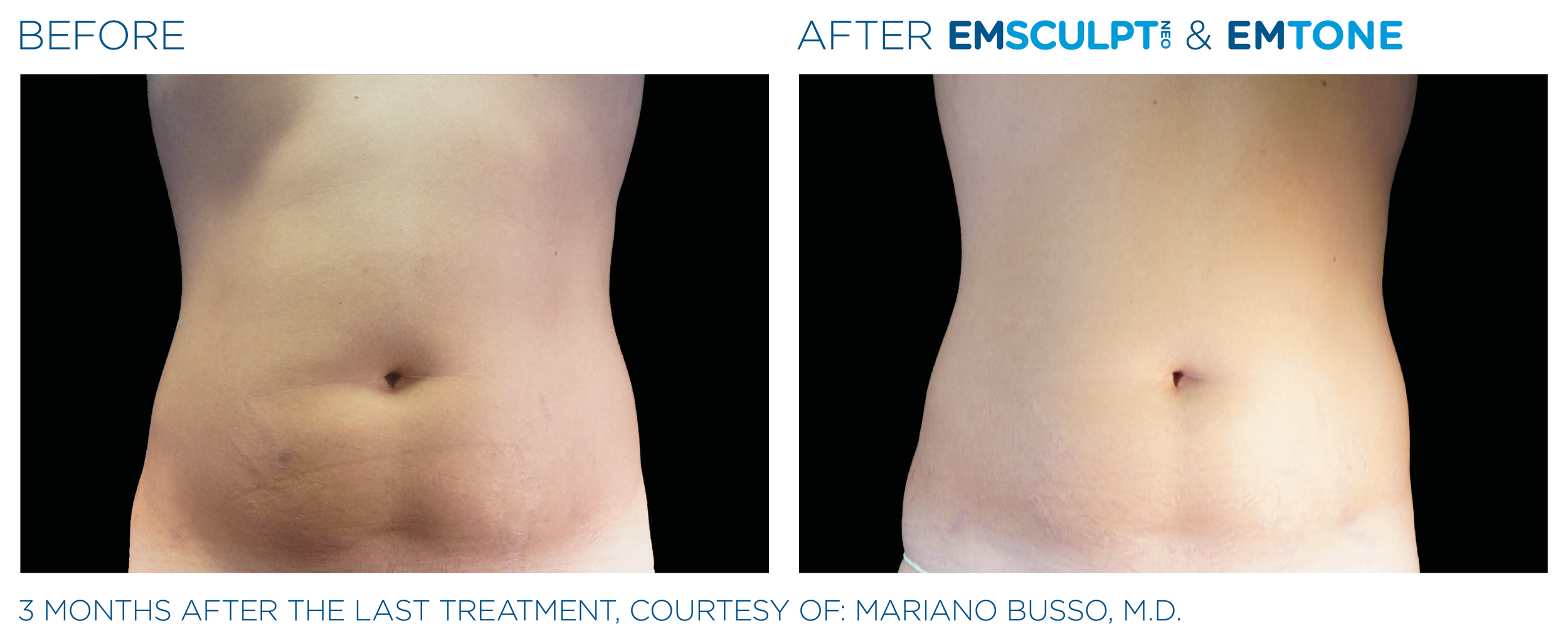 AbdomenEmsculpt_Neo-Emtone_PIC_Ba-card-male-abdomen-007_ENUS100.png