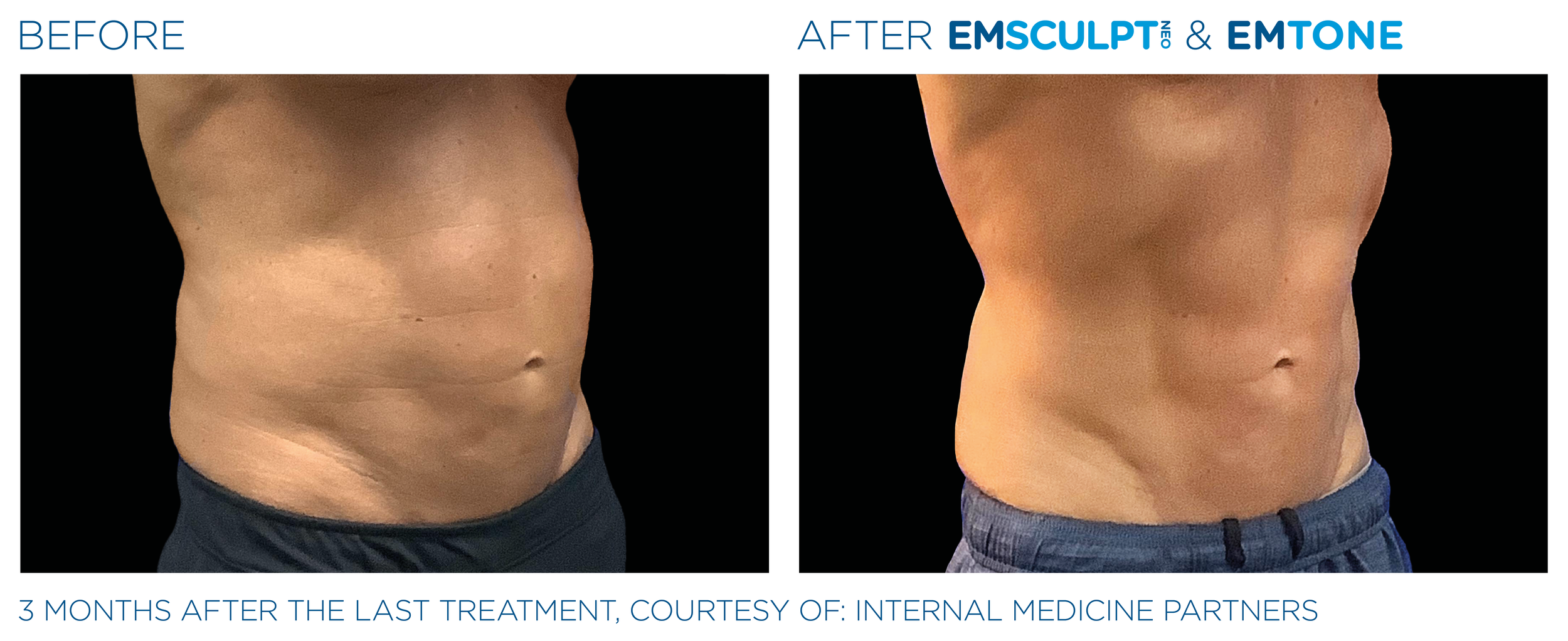 AbdomenEmsculpt_Neo-Emtone_PIC_Ba-card-male-abdomen-014_ENUS100.png