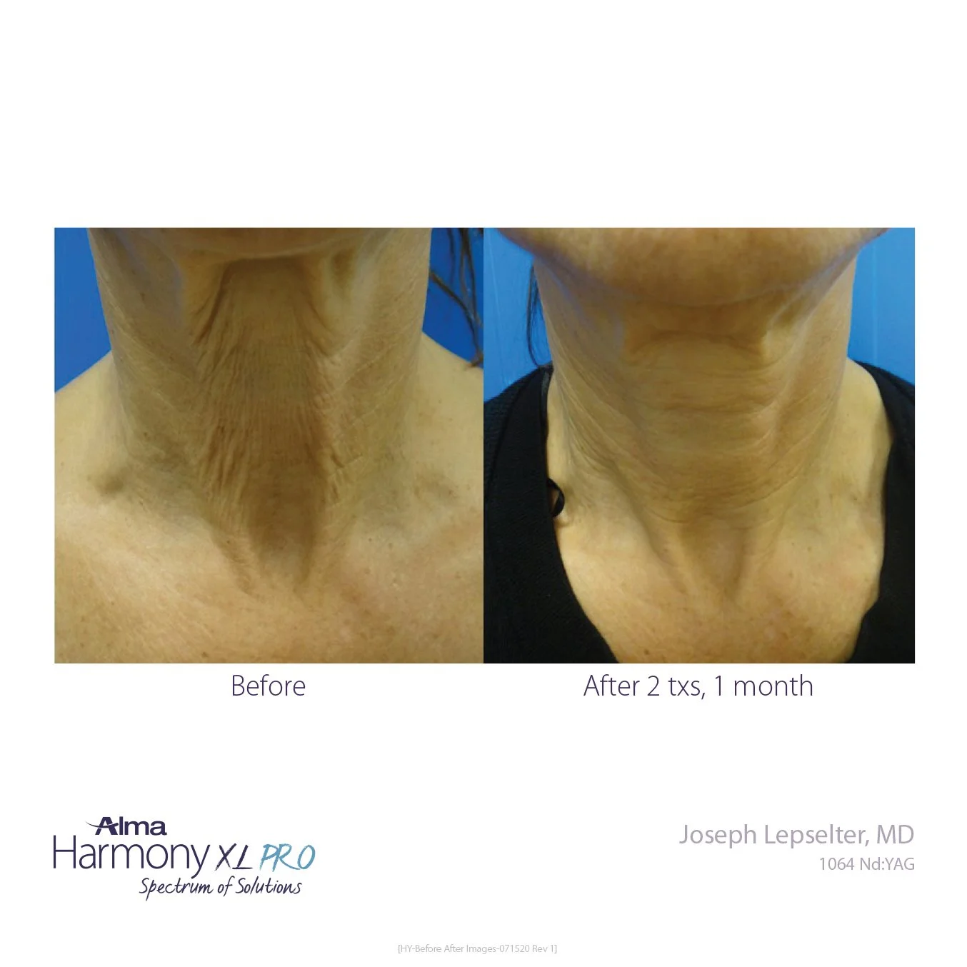 HY-Before-and-After-B2C-30.jpg