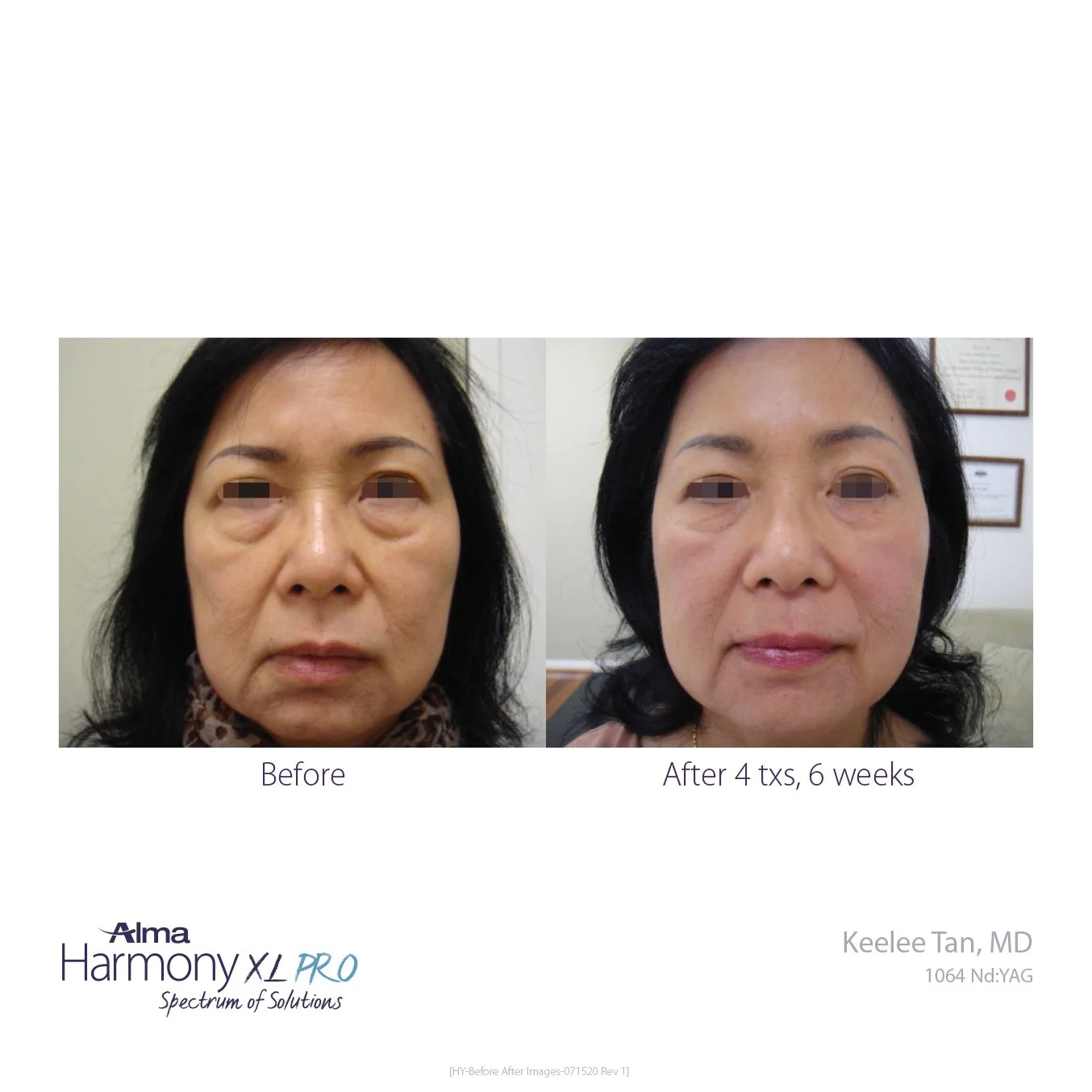 HY-Before-and-After-B2C-31.jpg