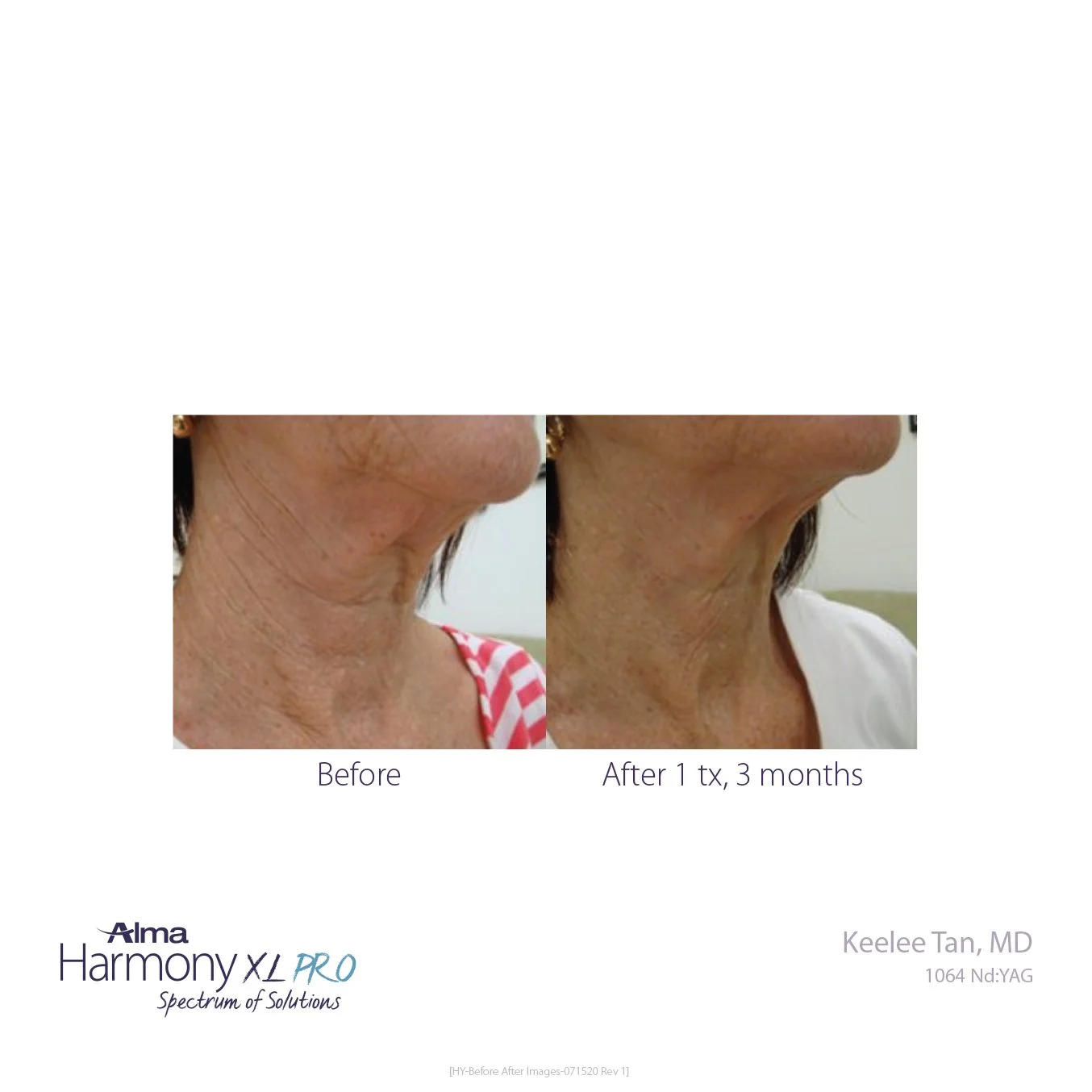 HY-Before-and-After-B2C-33.jpg