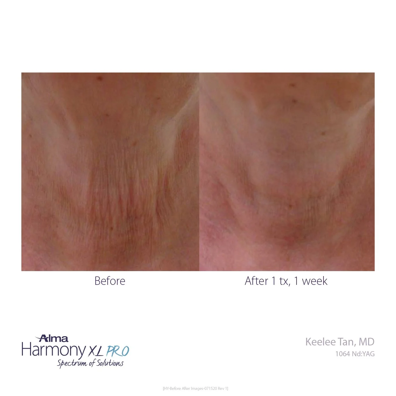 HY-Before-and-After-B2C-35.jpg