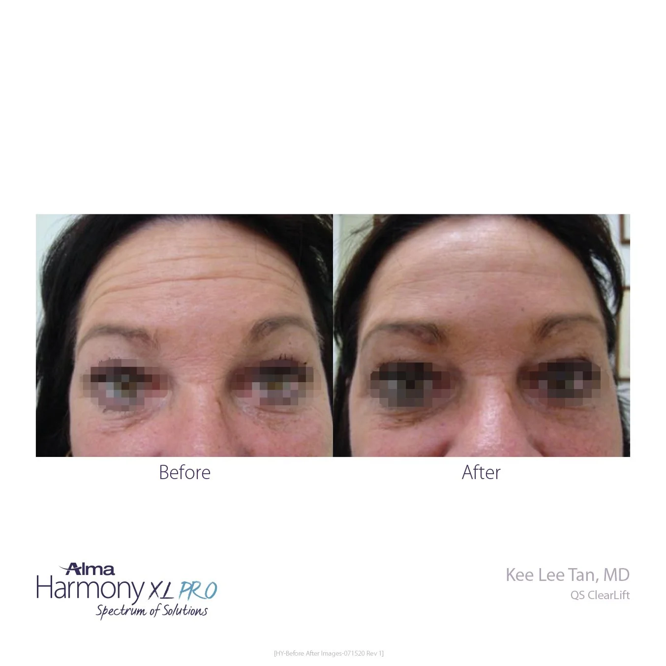 HY-Before-and-After-B2C-51.jpg