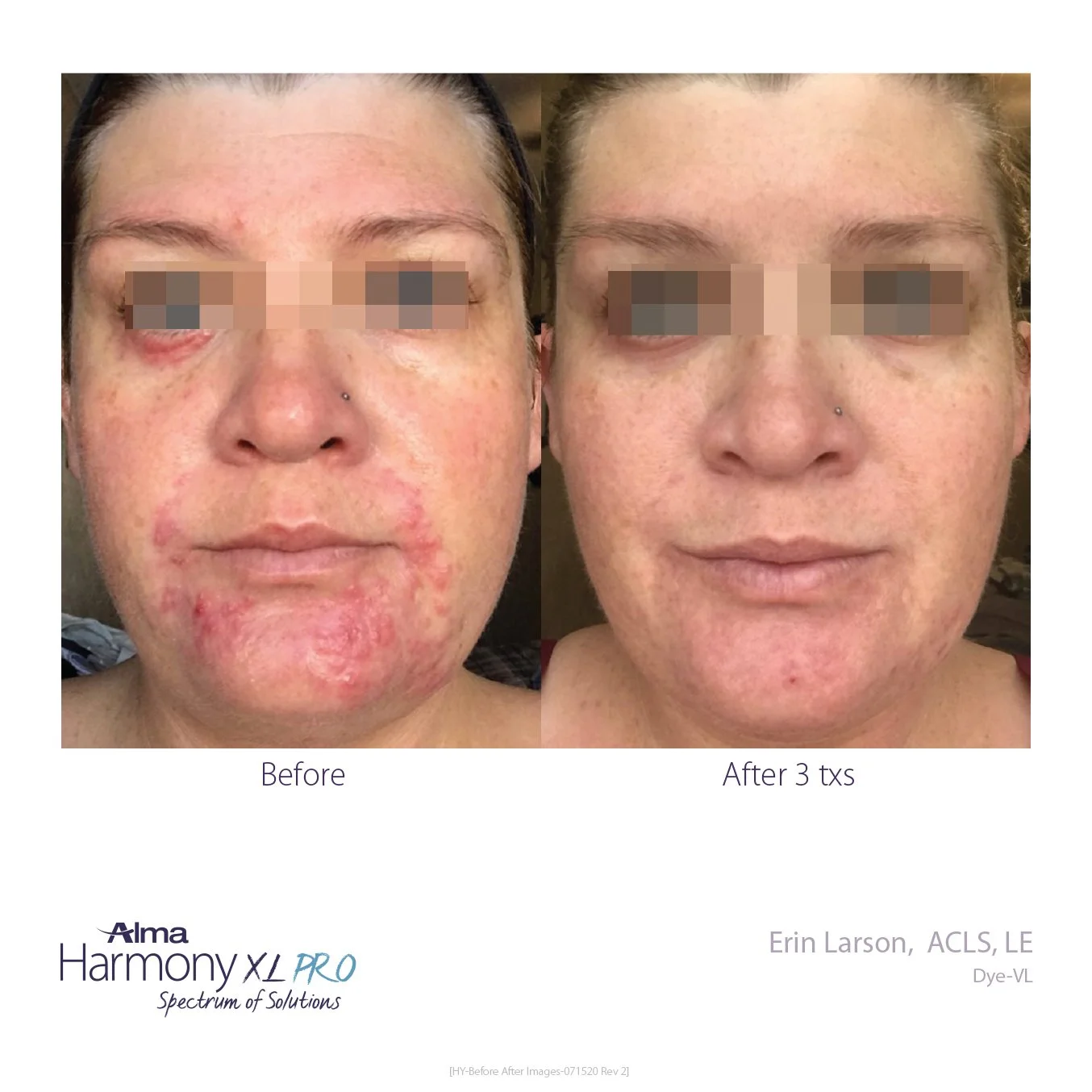 HY-Before-and-After-B2C-02.jpg