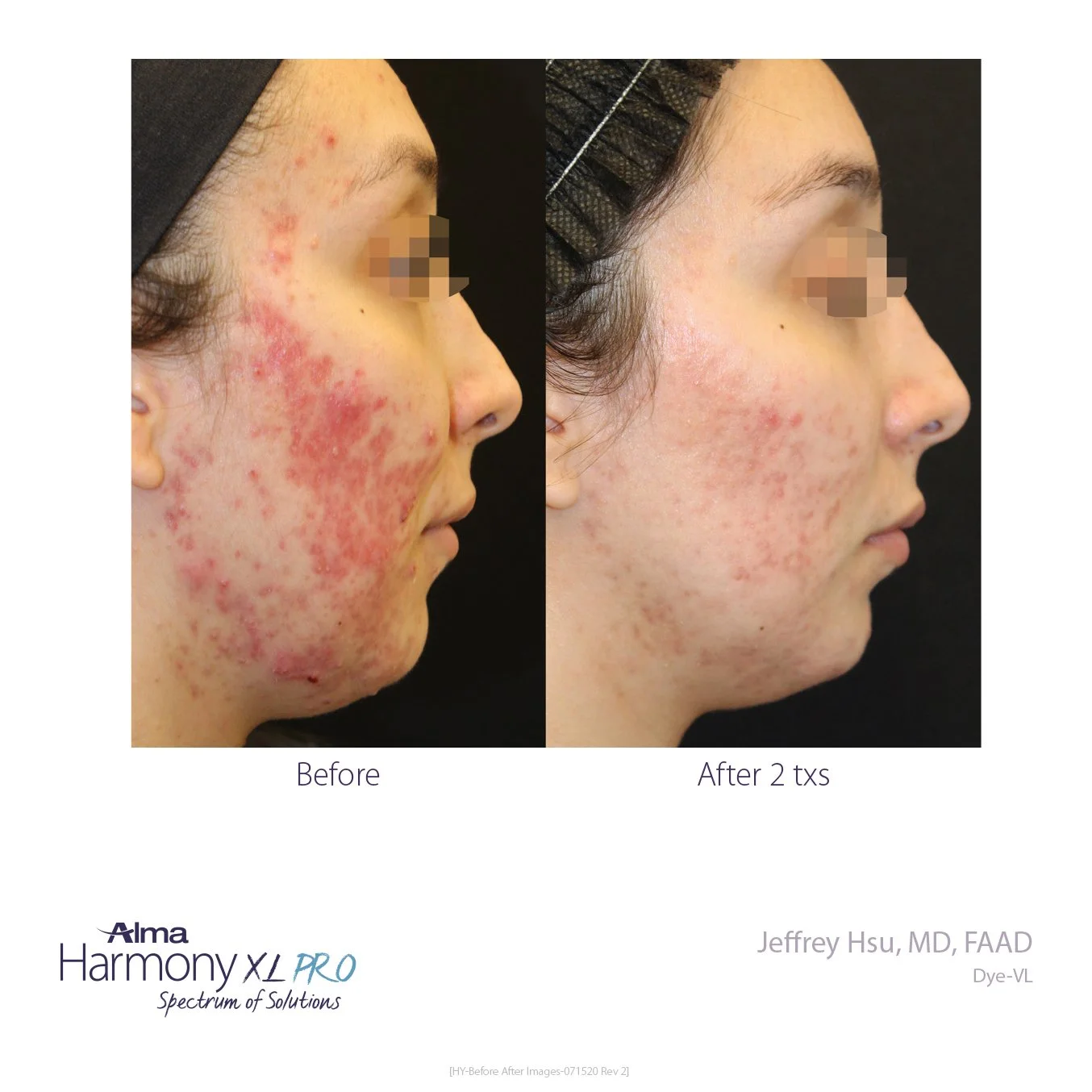 HY-Before-and-After-B2C-06.jpg