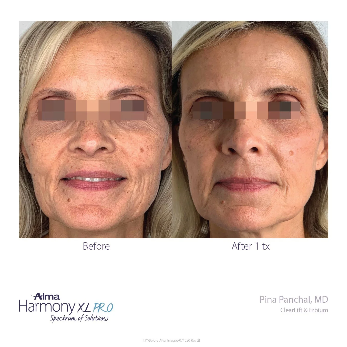 HY-Before-and-After-B2C-10.jpg