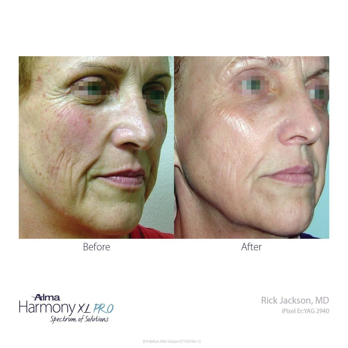 HY-Before-and-After-B2C-42.jpg