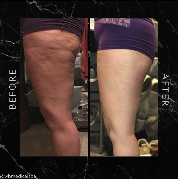 Fascia Legs Before After.png